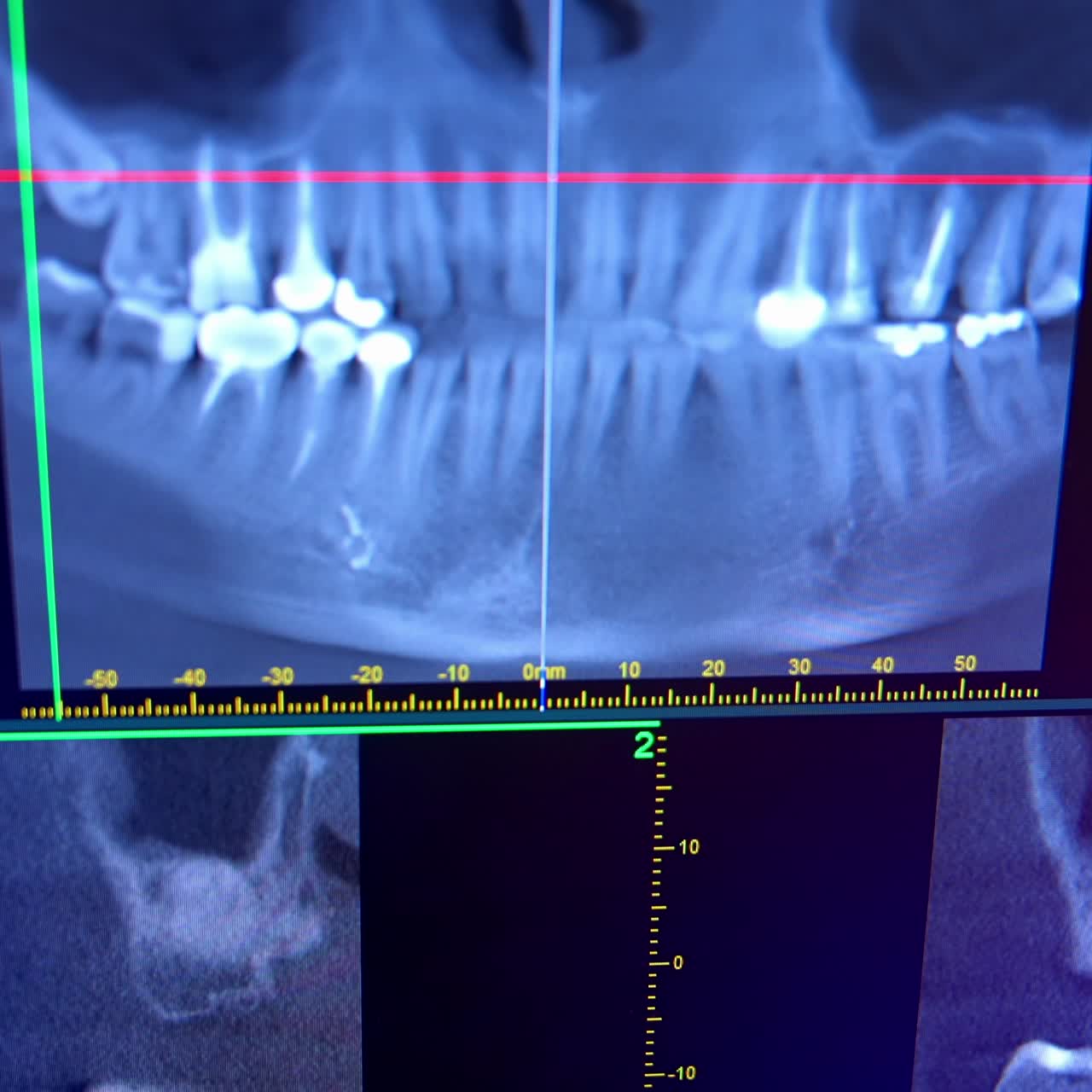 X-ray of oral cavity with teeth