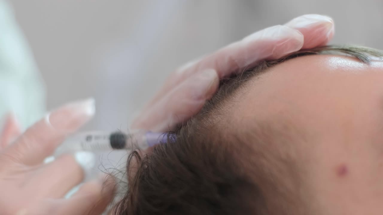 현대 화장품 클리닉에서 머리카락 mesotherapy 절차. trichologist는 머리카락 성장을 위해 남자의 머리카락에 주사를 만들고 탈모를 방지합니다.