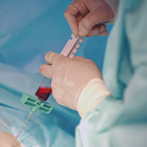 platelet-rich plasma preparation. plasma in syringe. modern equipment in operating room.