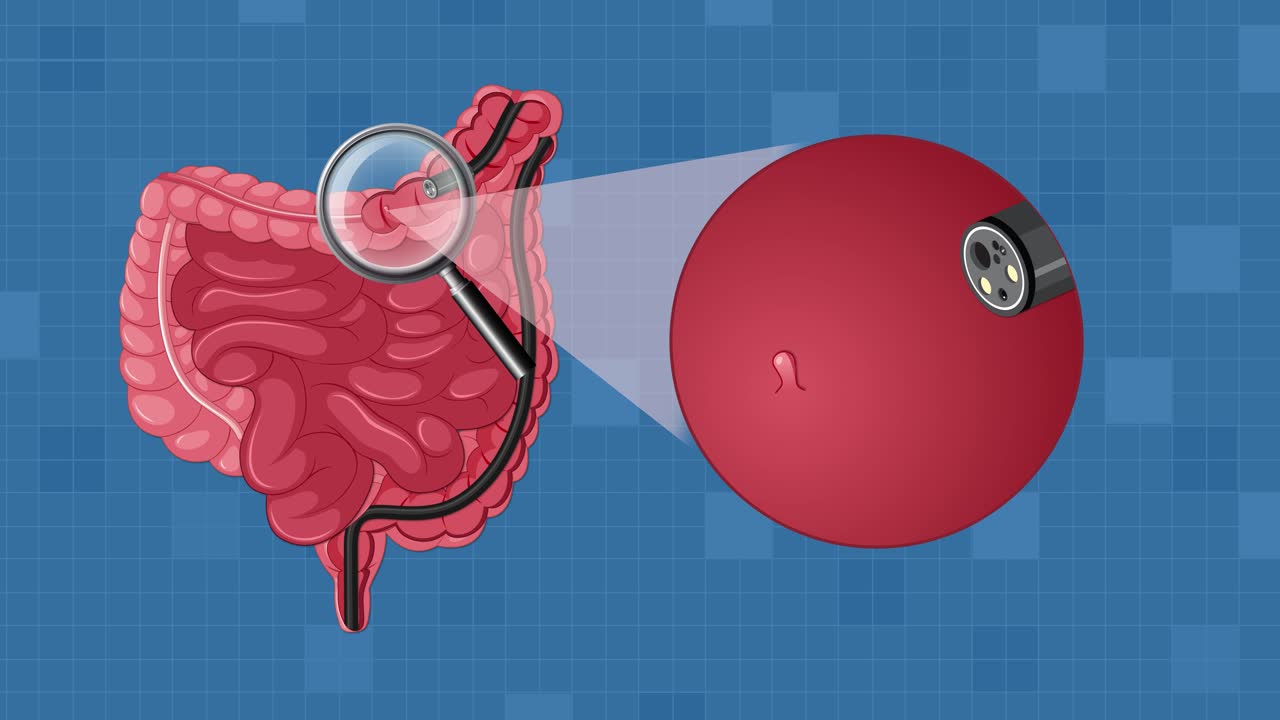 Animated sequence illustrating endoscopic removal of intestinal polyp using minimally invasive surgical tools