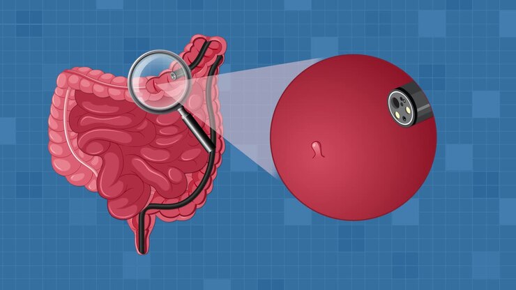 Animated sequence illustrating endoscopic removal of intestinal polyp using minimally invasive surgical tools