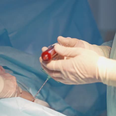 syringe with blood in doctor's hand. specialist making stem cells injection to a patient. close-up.