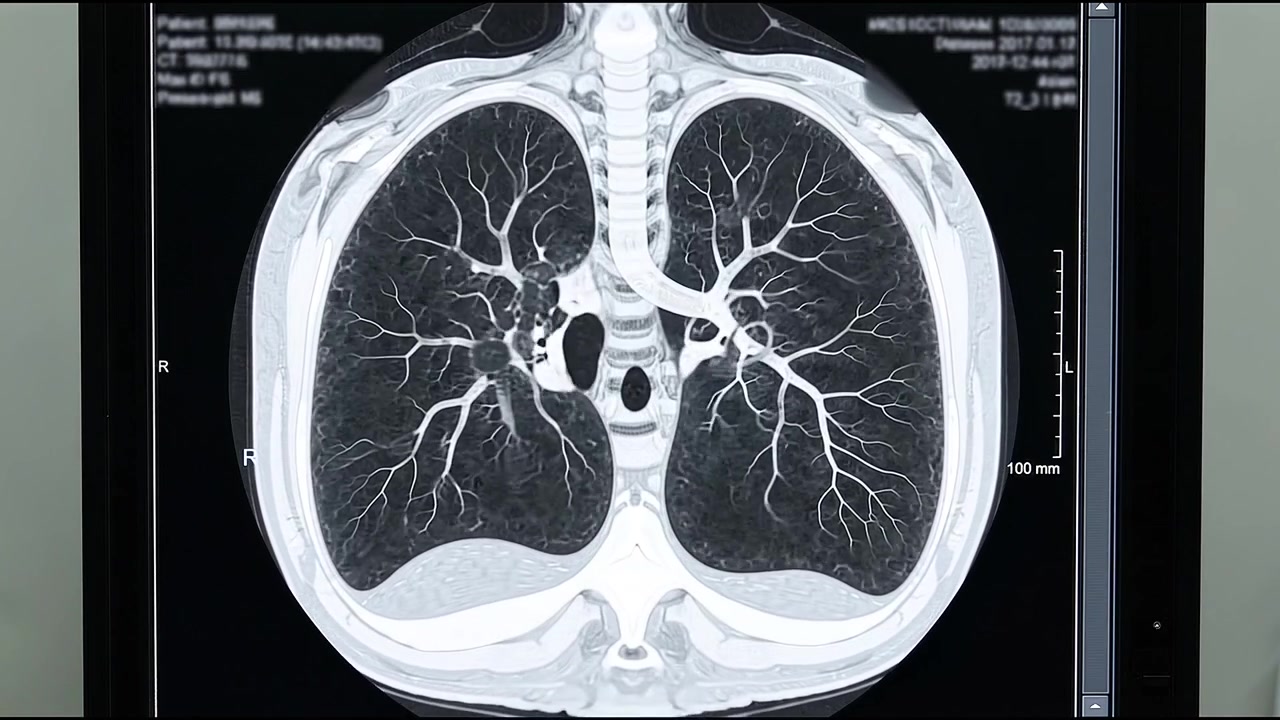 Lékařské CT vyšetření lidských plic zobrazující průřezovou anatomii