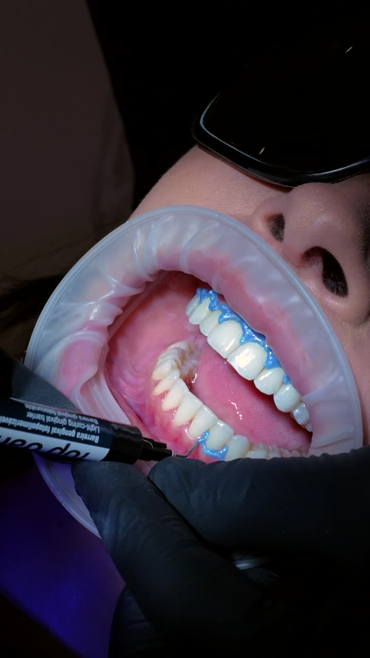 Dental procedure with gingival barrier application