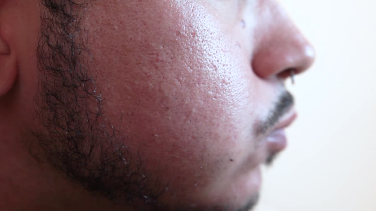 Giovane uomo con pelle problematica che mastica cibo