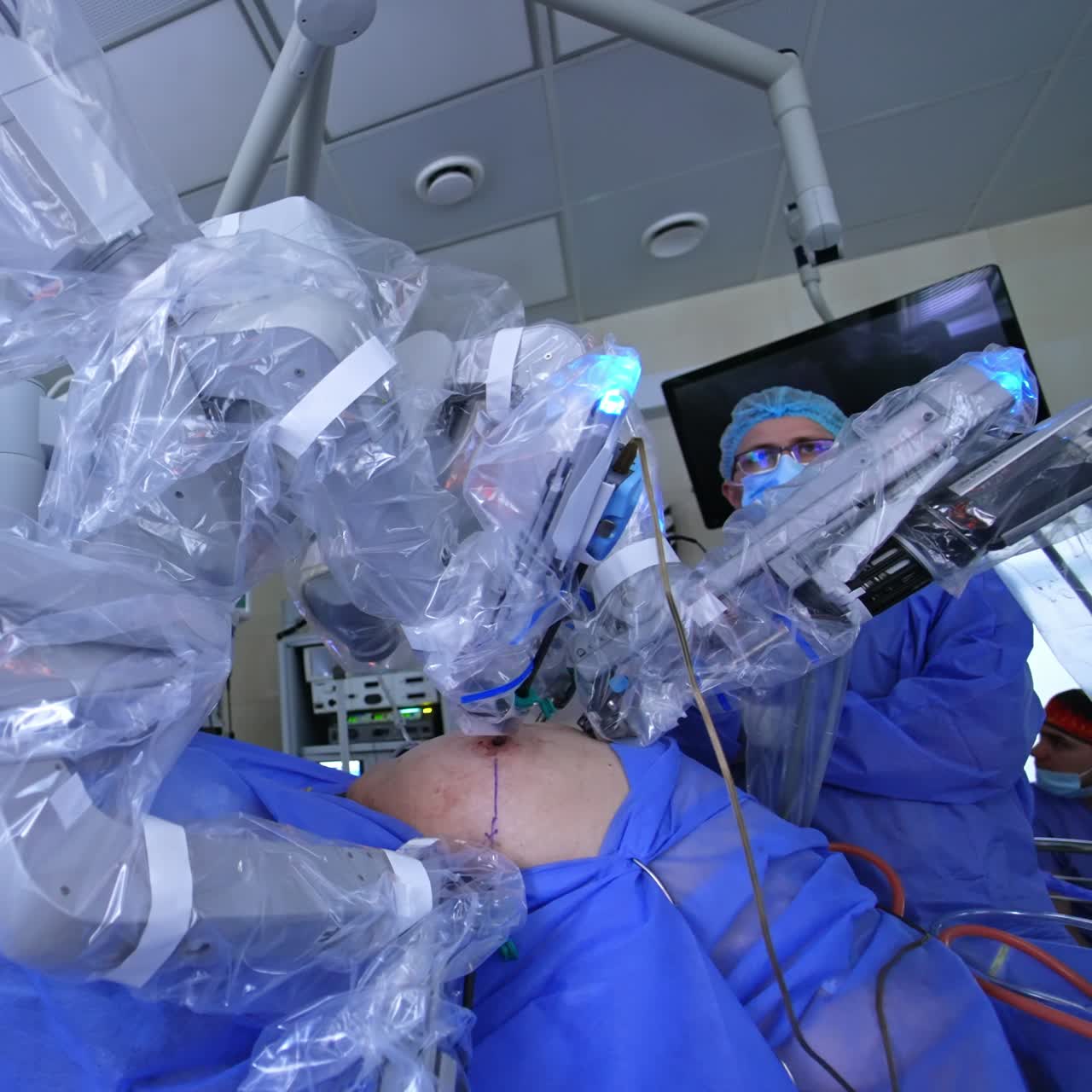 Laparoscopic operation carried out by the innovative robotic equipment. Low angle view. Medical staff at backdrop