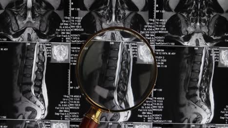 MRI-lumbar-spine-background,-magnetic-resonance-tomography.-Doctor-examines-MRI-of-lumbar-spine-with-pinched-discs-of-spine-and-nerves.