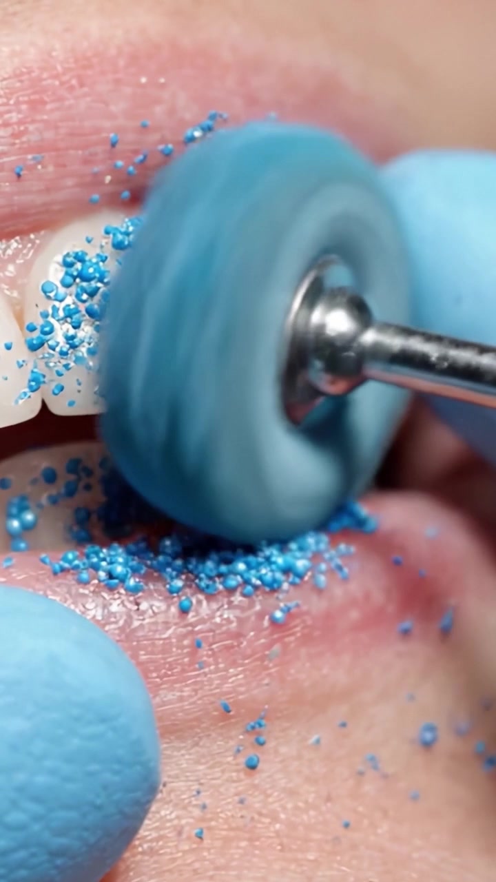 Procedimentos de Higiene Dental: Polimento Profissional dos Dentes Usando uma Taça de Borracha Azul para Melhorar a Saúde Oral e a Estética, Removendo Manchas e Acúmulo de Placa Bacteriana