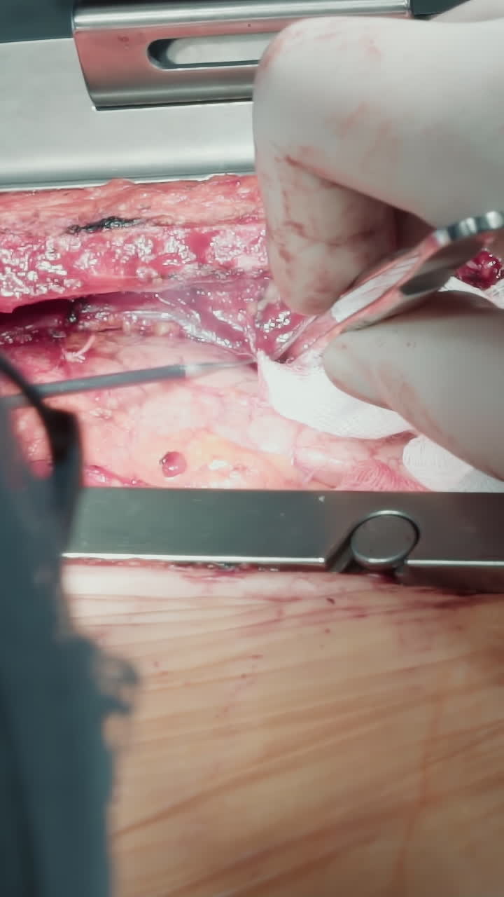 심장 수술 중에 작동하는 레이저 스칼펠: 외과 의사는 코로나 동맥 바이파스 중에 클리닉의 밝은 불빛 아래 레이저 스컬펠과 포을 조심스럽게 사용합니다.