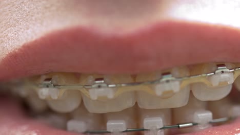 extreme close-up shot of a mouth with braces