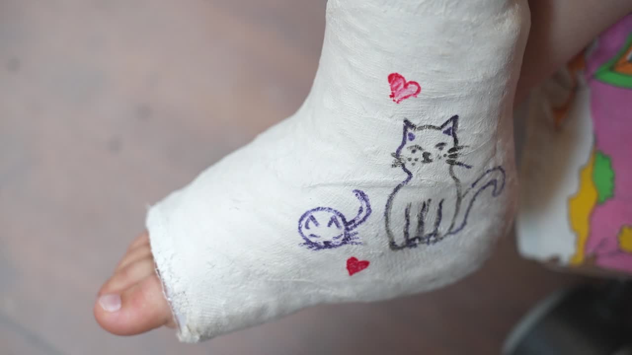pierna de yeso blanco con dibujos de gatos bonitos dibujados a mano y corazones rojos