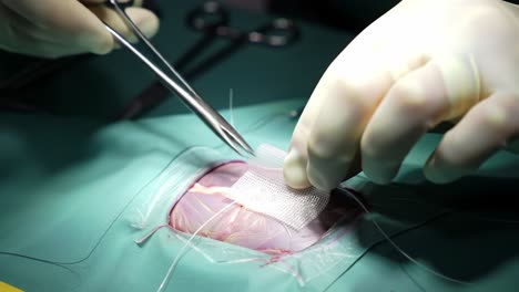 a close-up view of a surgical procedure highlighting the careful application of a sterile dressing to a surgical wound on a patient's skin during an operation.