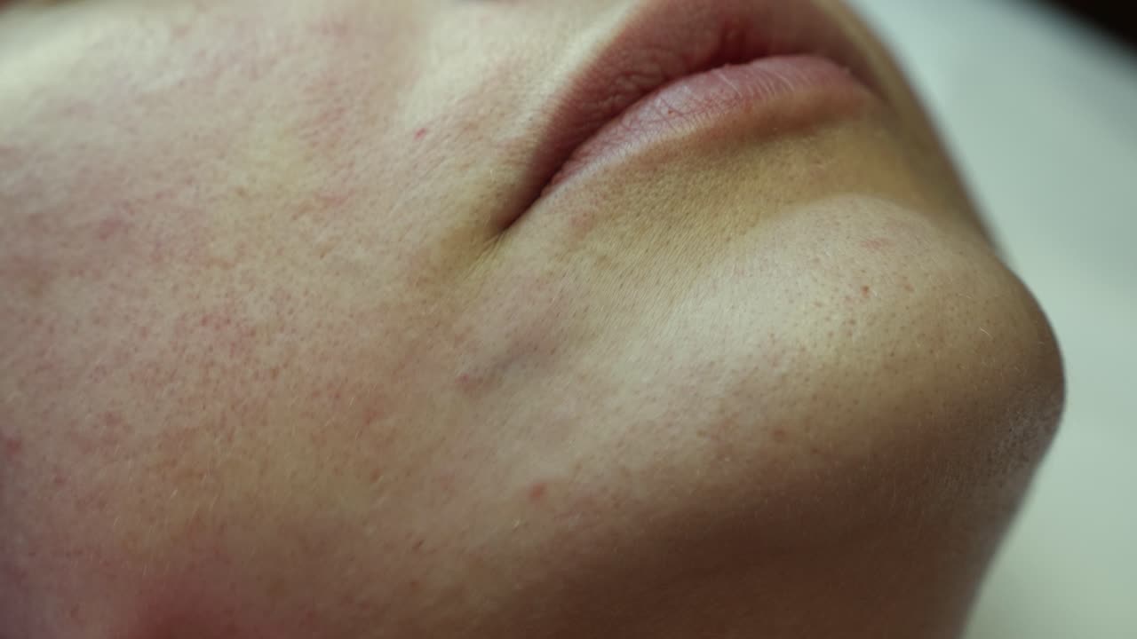 Dermal Filler Injection