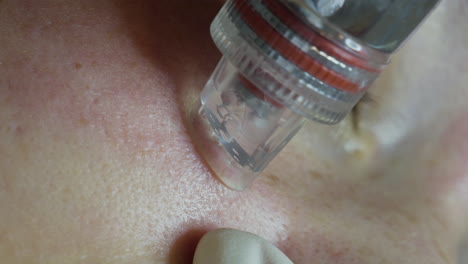 Close-up-of-the-aquapure-machine-being-applied-to-a-woman's-cheek-during-facial-cleansing