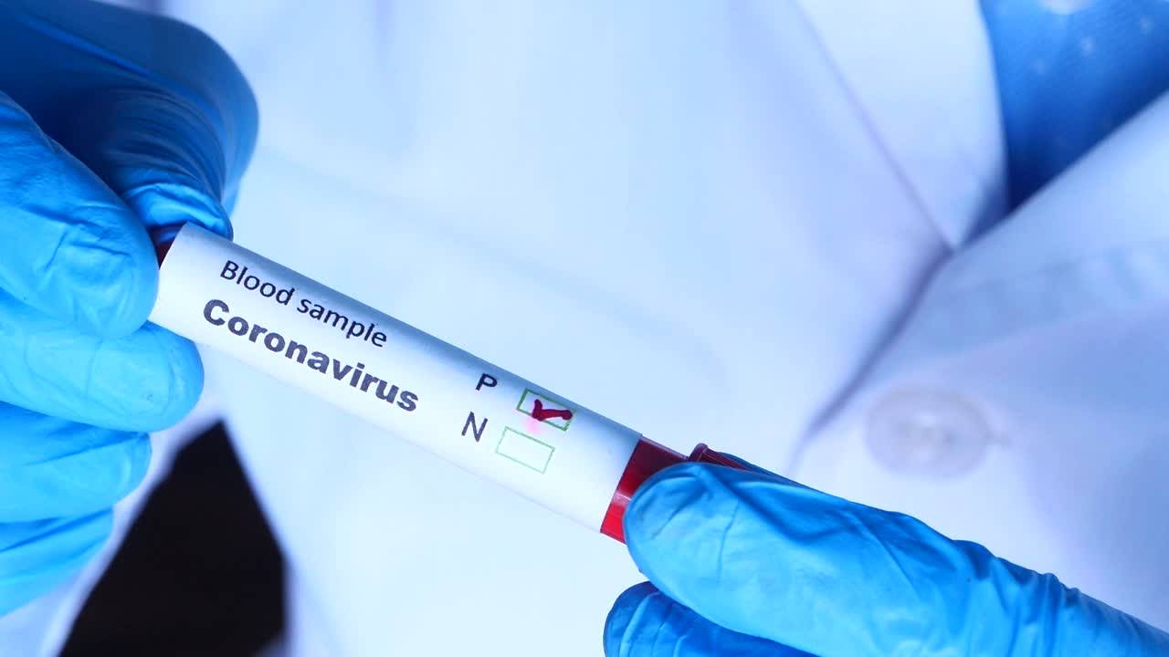 análisis de muestras de sangre de coronavirus