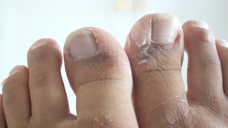 dry and cracked toes