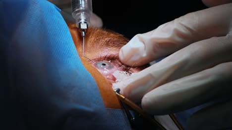 laser vision correction. a patient and team of surgeons in the operating room during ophthalmic surgery. eyelid speculum. lasik treatment. patient under sterile cover