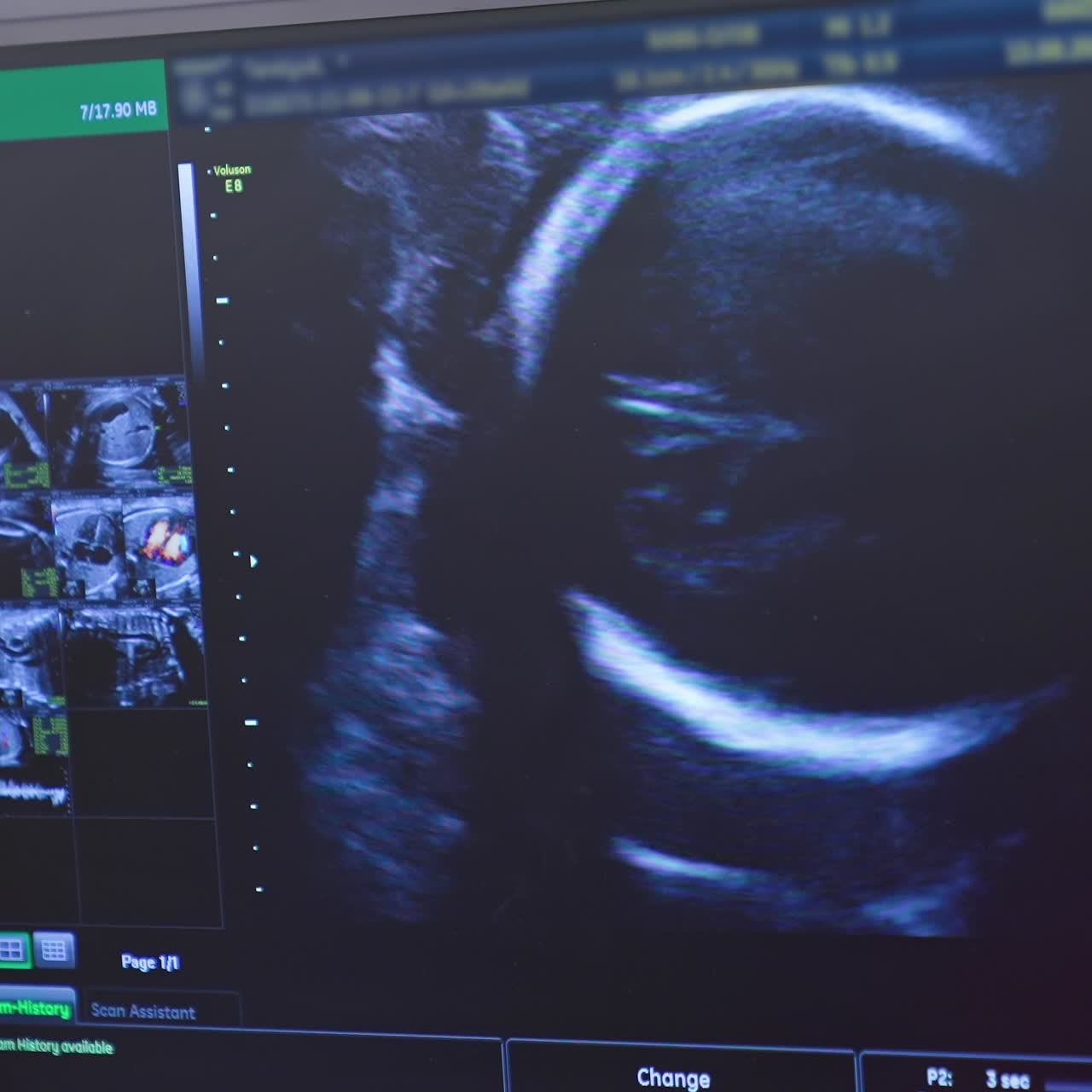 Pictures of fetus on the screen of monitor. Scientific analysis. Ultrasonography of pregnant woman. Ultrasound monitor displaying a small baby in pregnant woman's belly