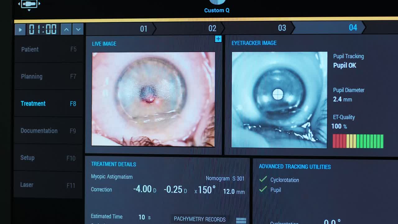 Ophthalmic surgery. View on the screen of medical monitor in operating room. Lasik