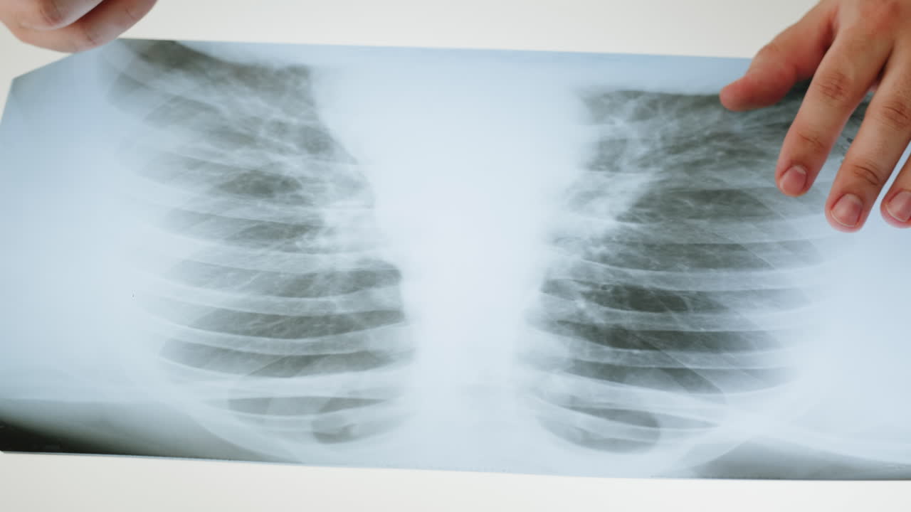 A doctor's hands pointing at a chest X-ray