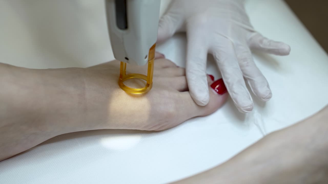 Apotrixosi Laser Hair Removal Treatment On Female Feet - Close Up