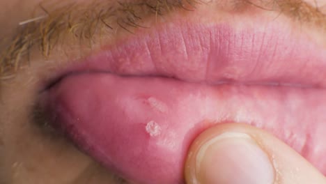 an aphtha oral inflammation on the gums close up