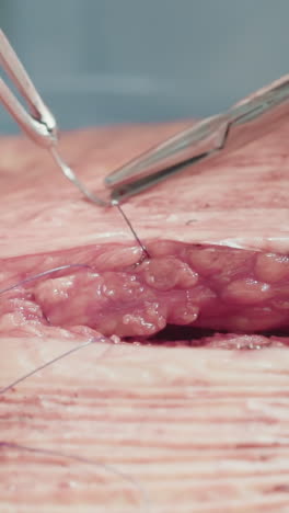las manos del cirujano cierran la capa subcutánea. el médico cuidadoso crea apoyo adicional utilizando suturas absorbibles para coser la cavidad después de la cirugía.