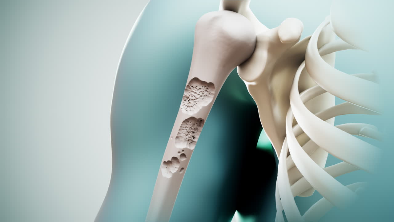 3D Animation Showing Osteoporosis and Bone Loss in Human Arm