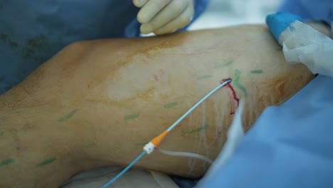aplicación de bioglue en el tratamiento quirúrgico de la úlcera de la pierna