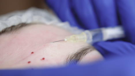 cosmetic procedure facial injection