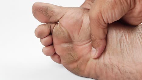 close-up of a person's foot with dry, cracked, and rough skin