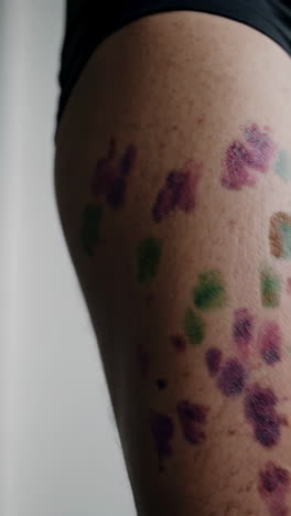 thigh with colorful bruises/marks