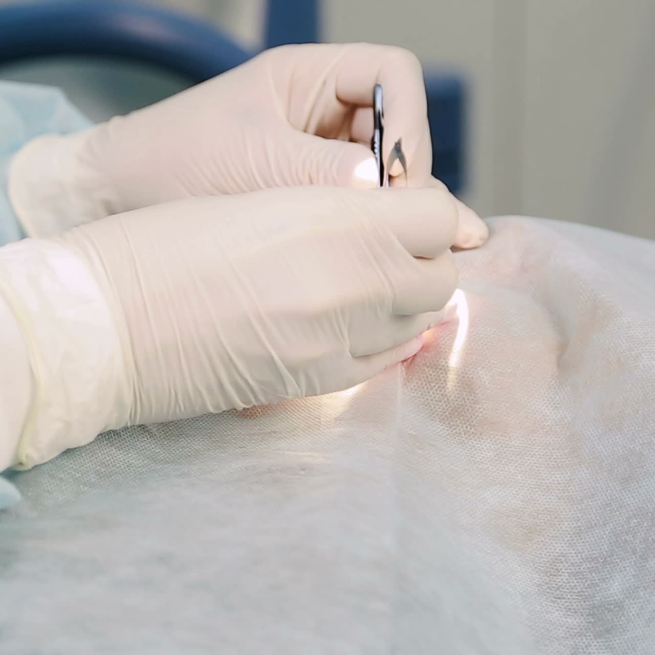 Laser vision correction