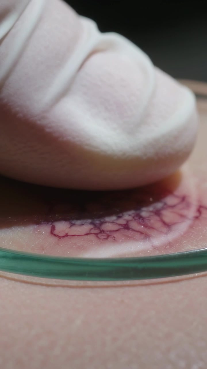 Video verticale: Dito con guanto bianco che preme una piccola tazza di vetro sulla pelle nuda, mostrando vene rosse.