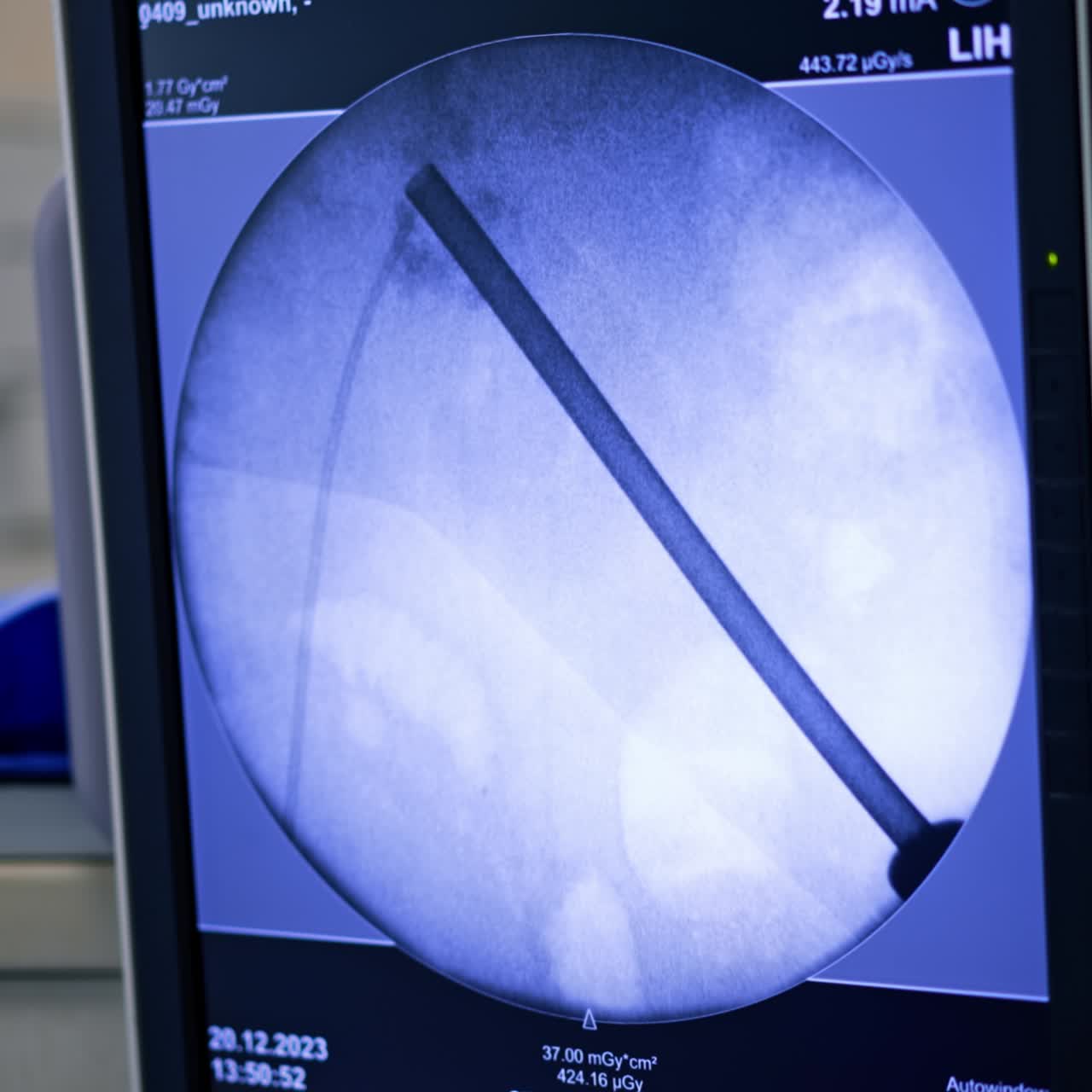 Röntgenbildschirm mit der laufenden Aufnahme. Ein Röhreninstrument ist auf dem Gerätemonitor sichtbar. Nahaufnahme.