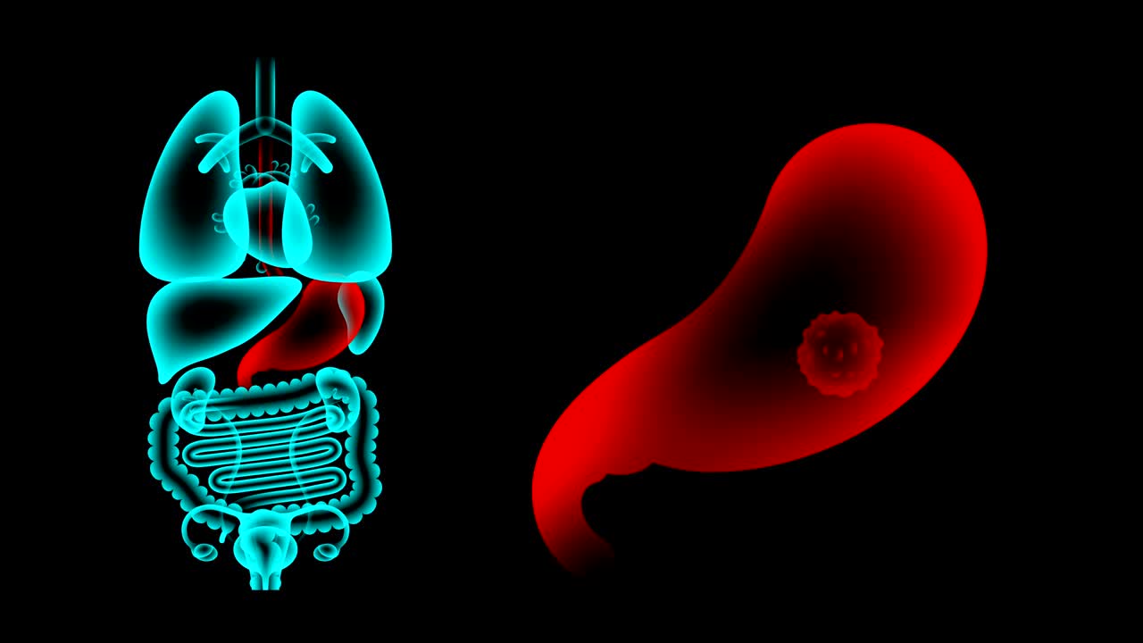 conjunto de rayos x de órganos femeninos humanos, infección estomacal idea concepto ilustración de color rojo brillo aislado en el fondo oscuro, animación de bucle sin costuras 4k con espacio de copia