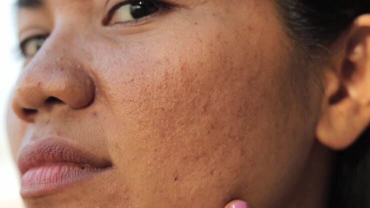 Woman Touching Her Face With Acne