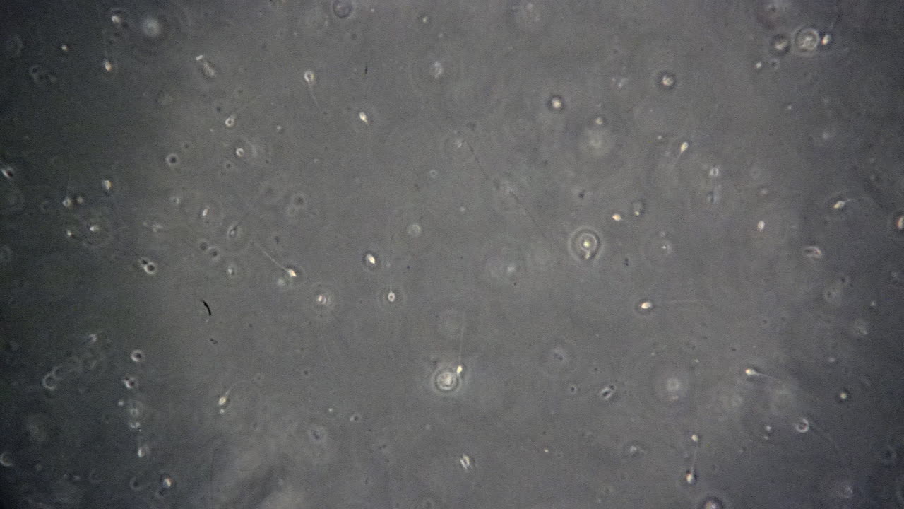 células espermáticas, algunas nadando, algunas muertas, vistas a través del microscopio