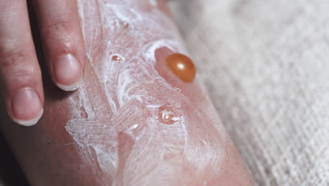 closeup of topical application medicine ointment applied to painful blisters swollen and infected