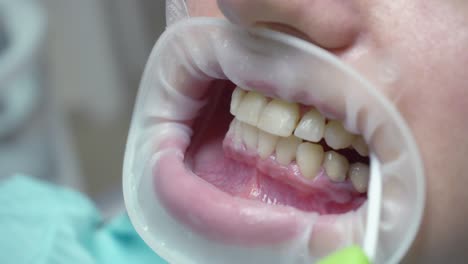 eliminación del gel blanqueador protector de los dientes. mujer joven con un expansor en la boca en la clínica dental. consultorio dental moderno. filmado en 4k