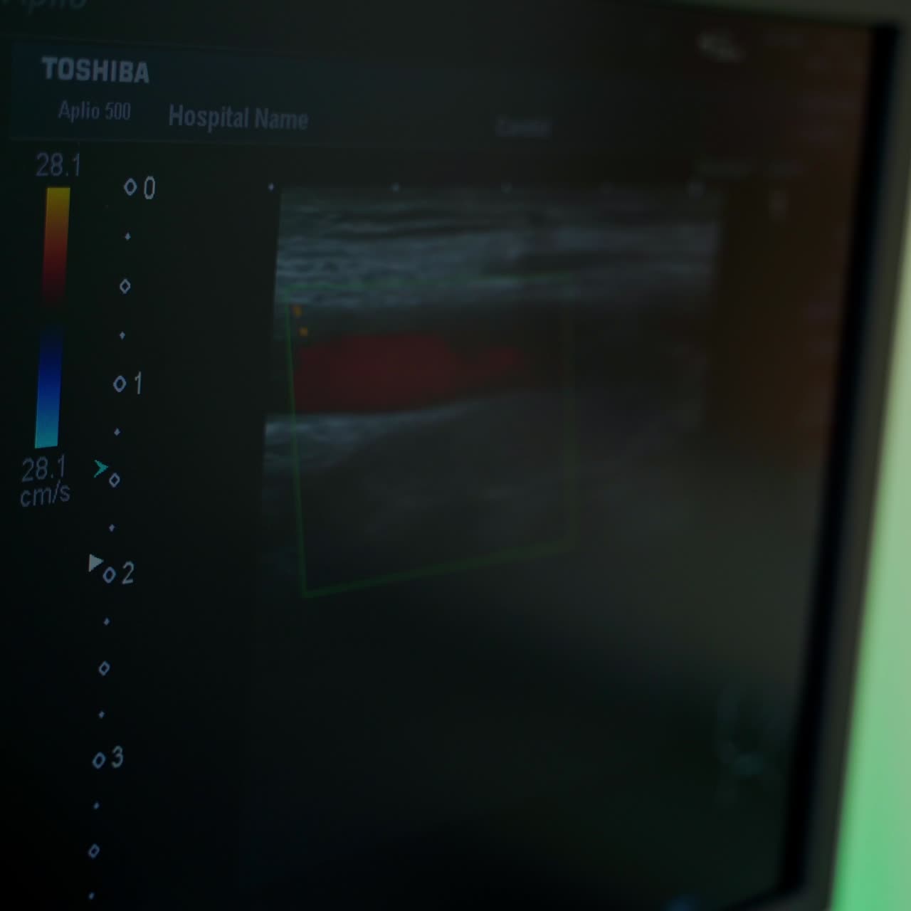 Screen displays ultrasound diagnostic. Monitor shows pictures of patient's organ during ultrasound examination. Modern equipment in clinic.