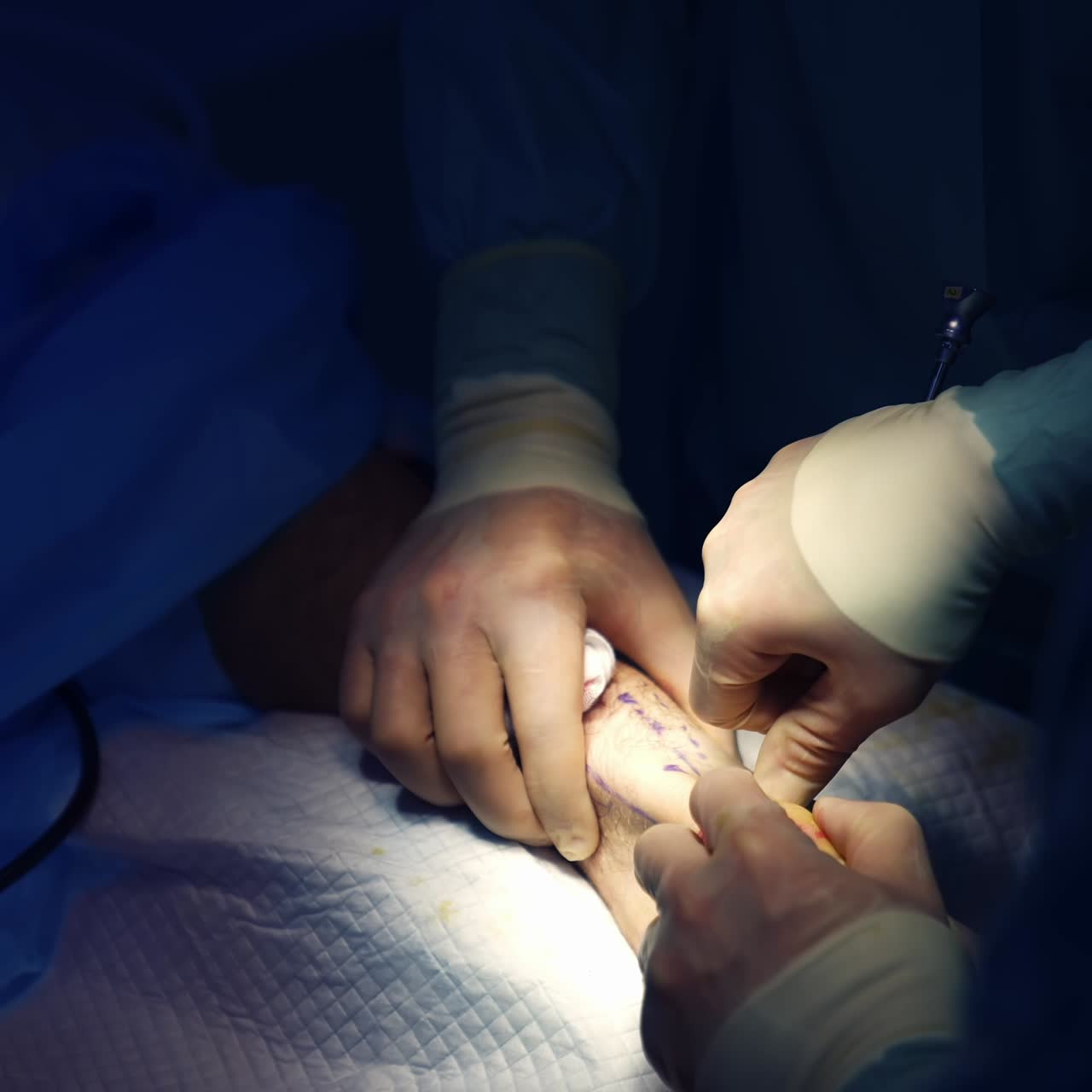 Surgery in light spot. Hands of doctors with medical tools performing an operation under the lamp. Surgical procedure. Close-up