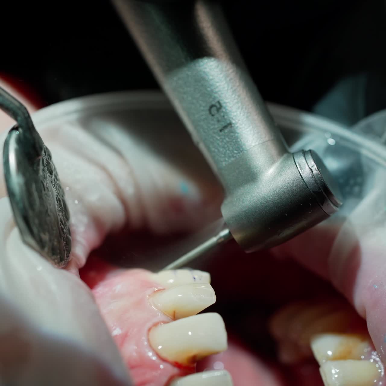 Patient's mouth during tooth treatment. Dentist's hands working with dental tools to treat sick tooth. Stomatology procedure. Close-up.