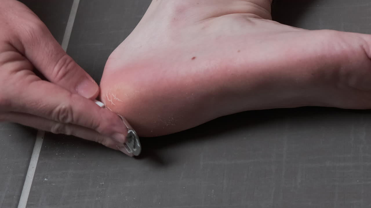 Uomo che rimuove duroni e calli dai piedi usando una lima rasoio, cura della pelle maschile, malattia della pelle, micosi, trattamento della pelle