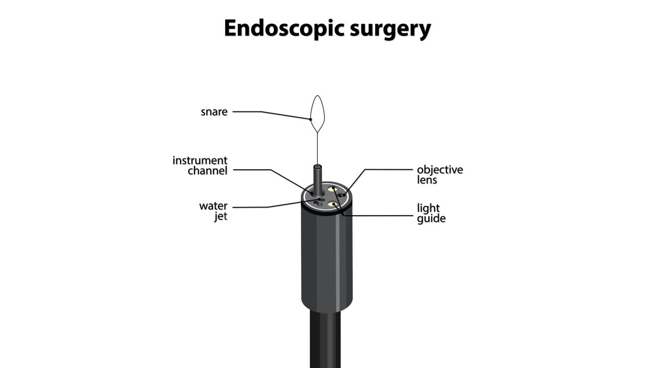Medical animation illustrating endoscopic surgery procedure inside large intestine, highlighting tool movement and anatomy