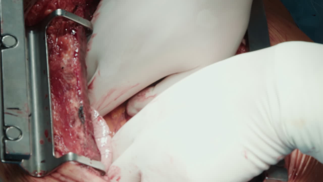 chirurgo conduce un intervento di bypass cardiaco. medico esegue un intervento per ripristinare l'efficiente flusso sanguigno al cuore in una sala operatoria all'avanguardia