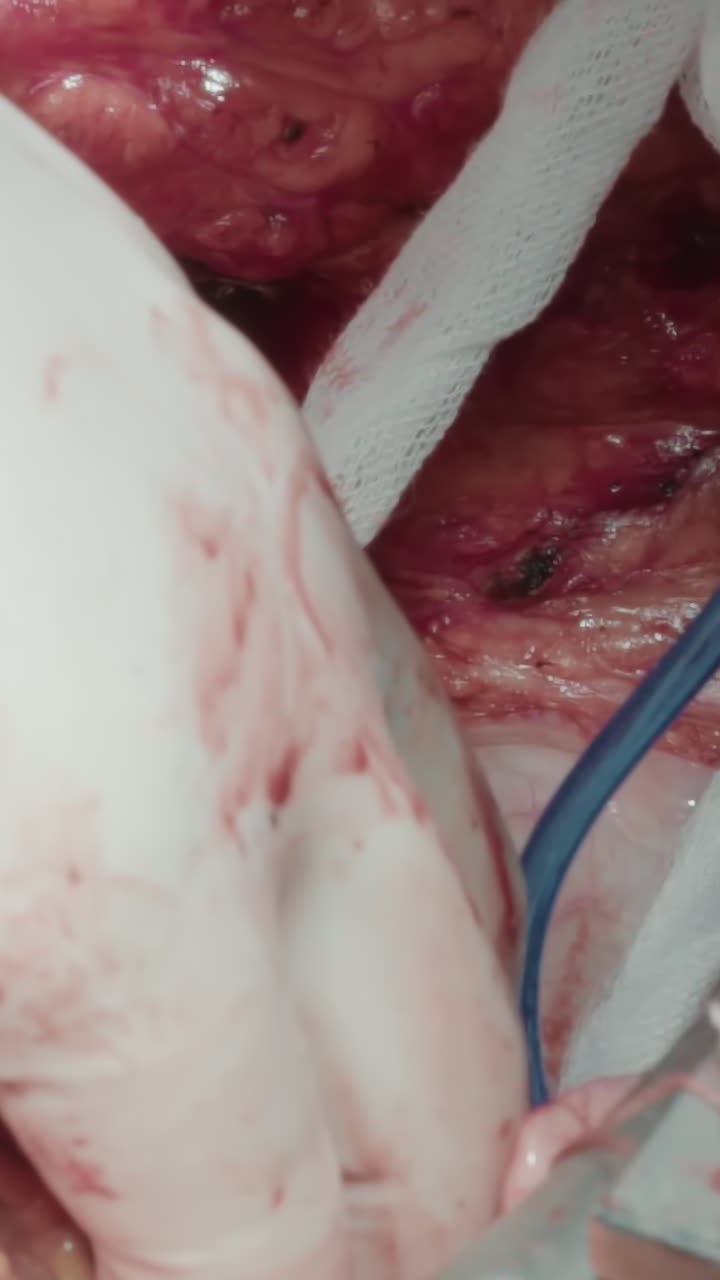 proceso de cirugía en cardiología. la mano del cirujano fija nuevos injertos para desviar el suministro de sangre. el médico injerta vasos en las arterias coronarias más allá de la obstrucción