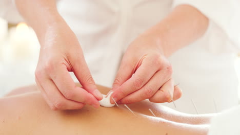 closeup of acupuncture, hands removing filiform