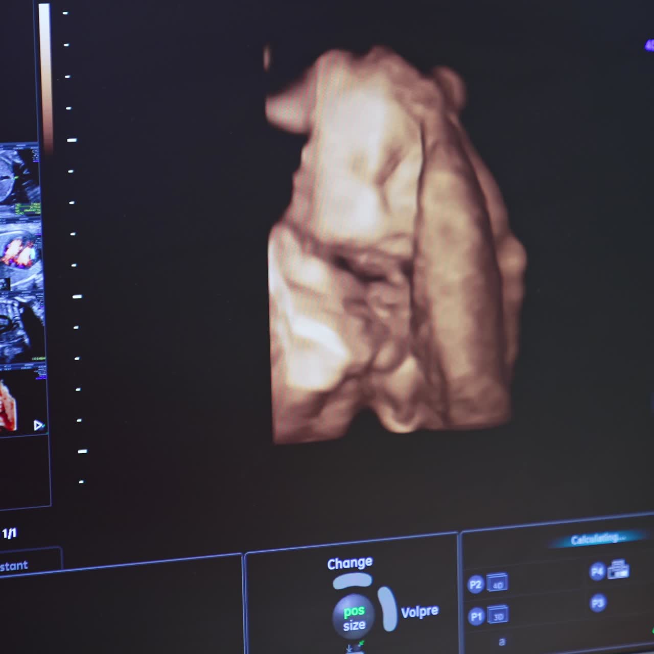 L'embrione umano muove la testa su uno schermo ecografico. Monitor ecografico che mostra il corpo del bambino durante una procedura di ecografia a una donna incinta.