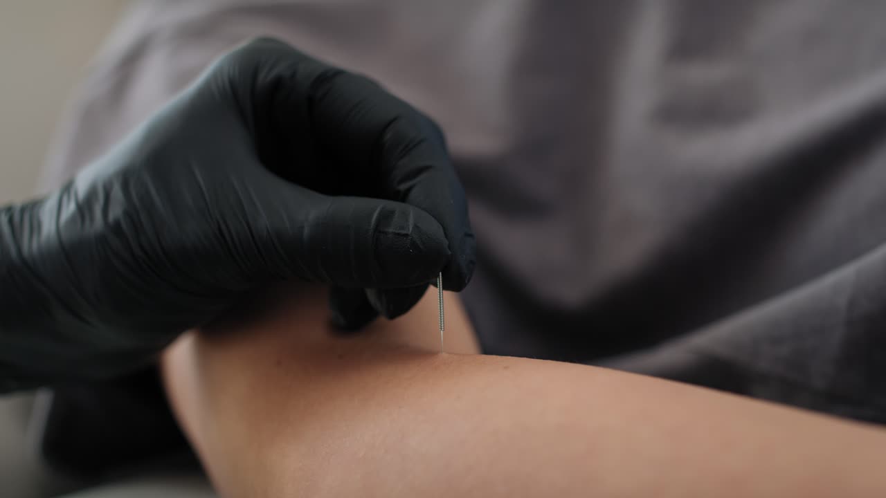 Close up of acupuncture specialist inserting needle into patient's hands due treatment.
